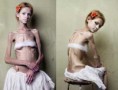 /album/anorexia-nervosa/anorexia-nervosa1-jpg/